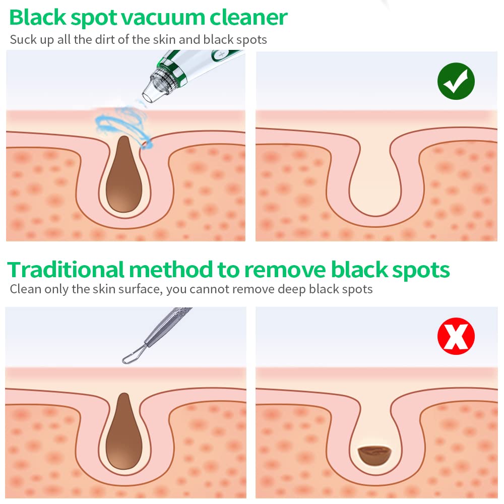 2023 Newest Blackhead Remover Pore Vacuum,Upgraded Facial Pore Cleaner,Electric Acne Comedone Whitehead Extractor Tool-5 Suction Power,5 Probes,USB Rechargeable Blackhead Vacuum Kit for Women & Men - Image 6